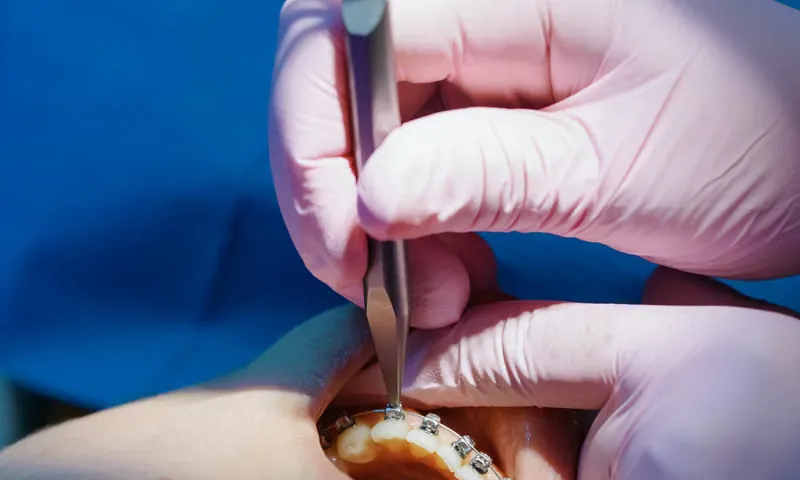 A Modern, Comfortable Path to a Straight Smile — Braces Sarjapura