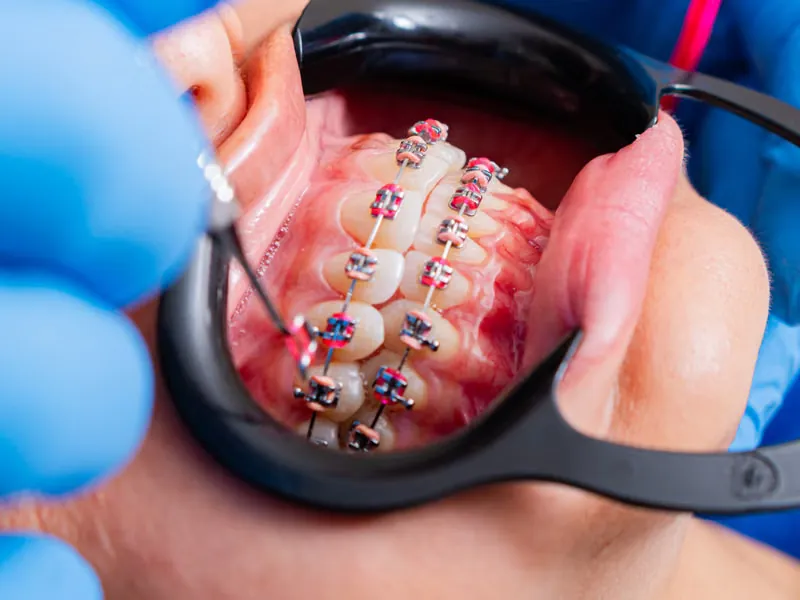 Benefits of Ceramic Braces for Kids — Ceramic Braces Sarjapura