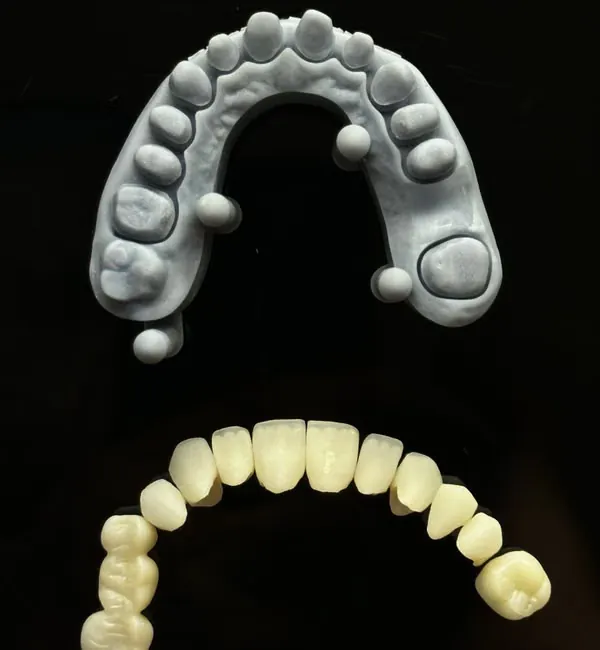 PFM dental cast and prosthetic crown arrangement — cost-effective posterior tooth restoration Sarjapura