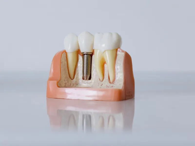 What to Expect from Start to Finish — Dental Implants Process Sarjapura