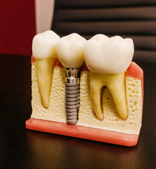 Transparent dental model showing implant screws for implant-supported denture — Deekshu Dental Bangalore