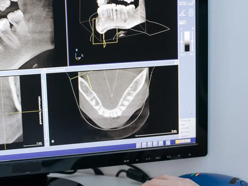 Digital X-ray and CBCT 3D imaging used for root canal diagnosis at Deekshu Dental, Sarjapura Bangalore