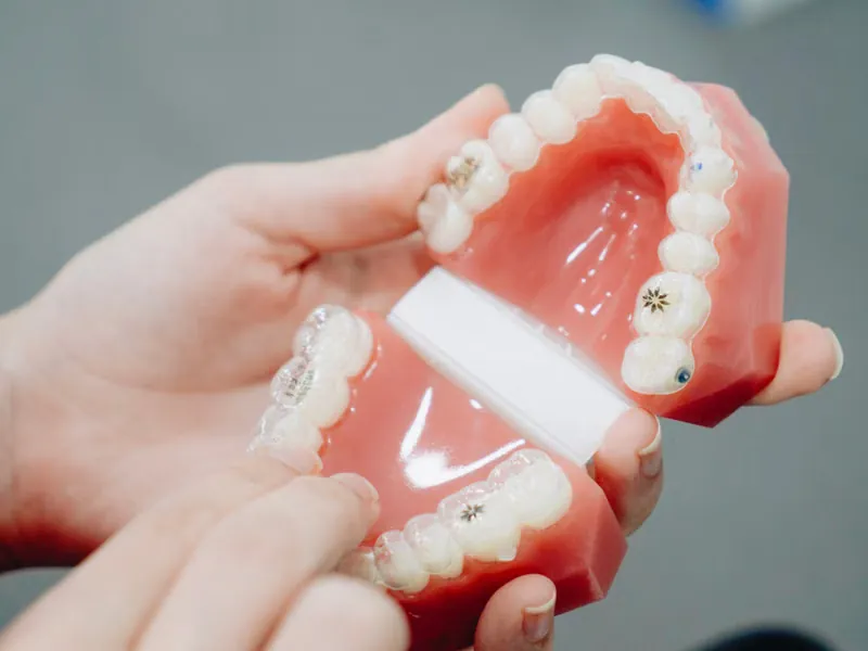 Hands examining a dental cast with orthodontic brackets used for gap and diastema assessment at Deekshu Dental, Sarjapura